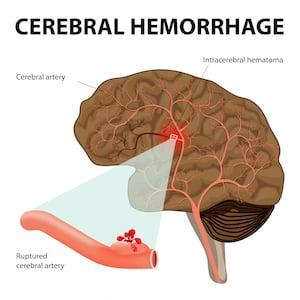 Cerebral Hemorrhage